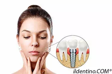 Implantologia dentale | ildentino.COM® Centro dentistico Torino