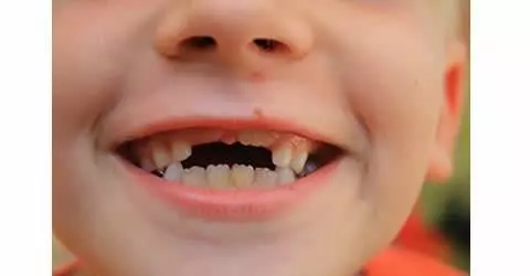 bambino senza denti decidui